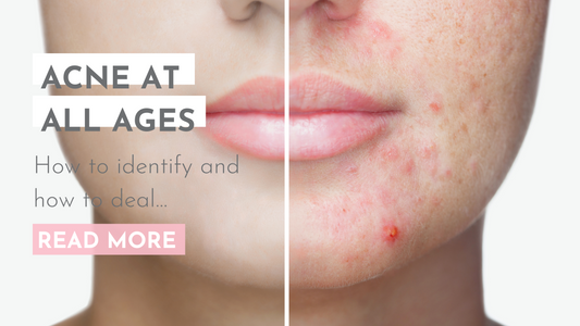 ACNE AT ALL AGES - How to Identify and How to Deal...